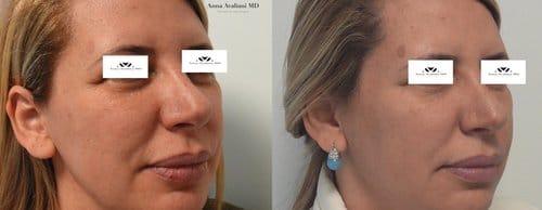 Fillers before and after, result 36