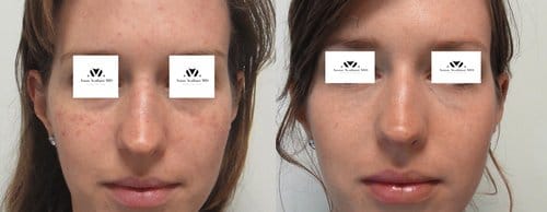 Fillers before and after, result 37