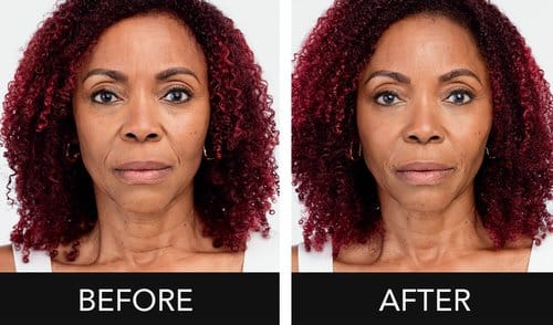 Radiesse before and after, result 5