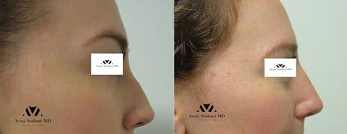 Fillers before and after, result 38