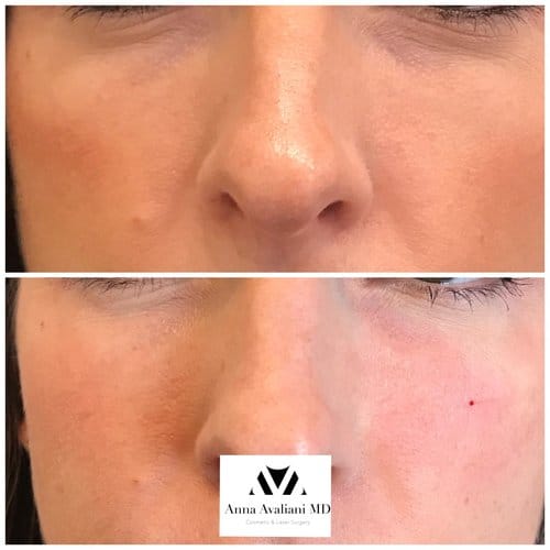 Fillers before and after, result 22