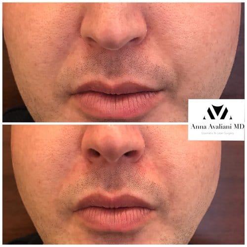 Fillers before and after, result 23