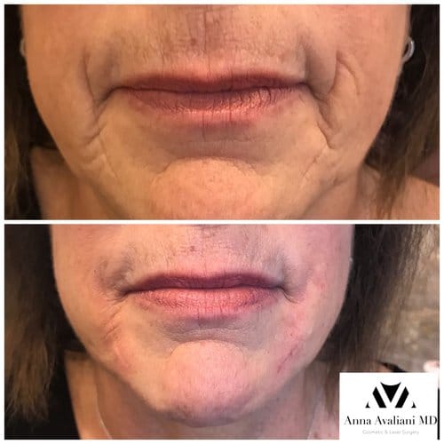 Fillers before and after, result 24