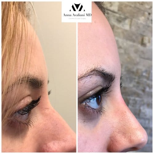 Fillers before and after, result 25