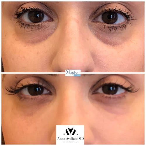 Fillers before and after, result 26