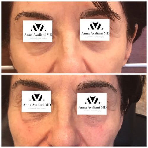 Fillers before and after, result 27