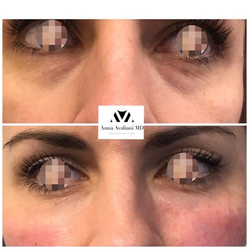Fillers before and after, result 28