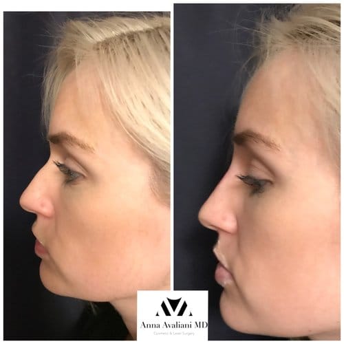 Fillers before and after, result 29