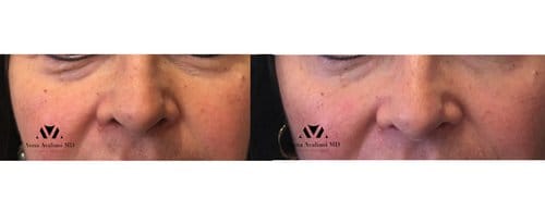 Fillers before and after, result 39