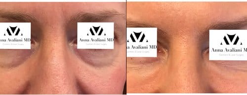 Fillers before and after, result 33