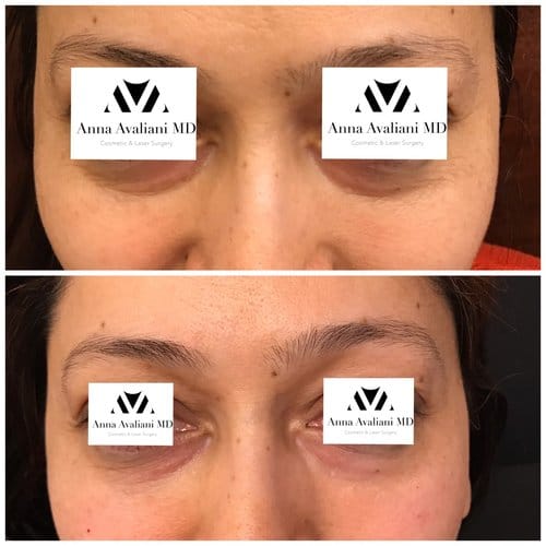 Fillers before and after, result 16
