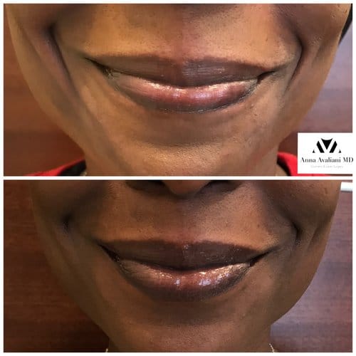 Fillers before and after, result 17