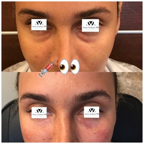 Fillers before and after, result 18
