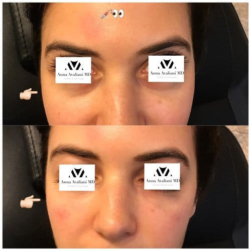 Fillers before and after, result 19