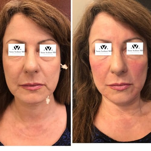Fillers before and after, result 20