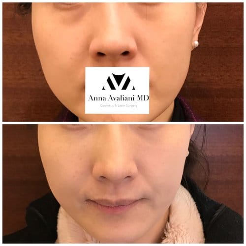 Fillers before and after, result 21