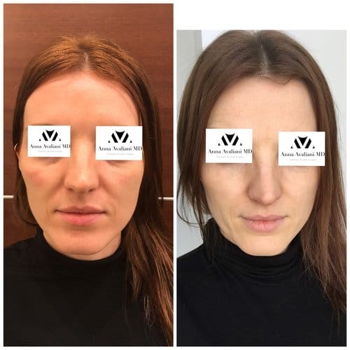 Fillers before and after, result 32
