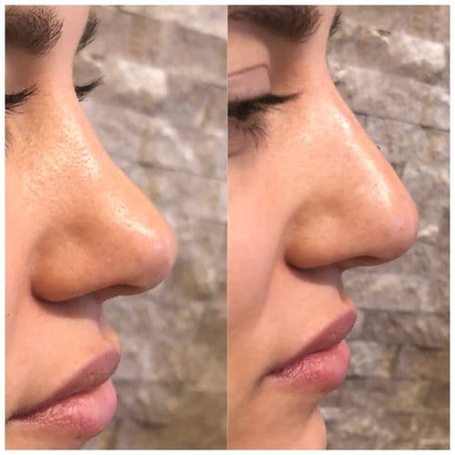 Non Surgical Nose Job before and after, result 14