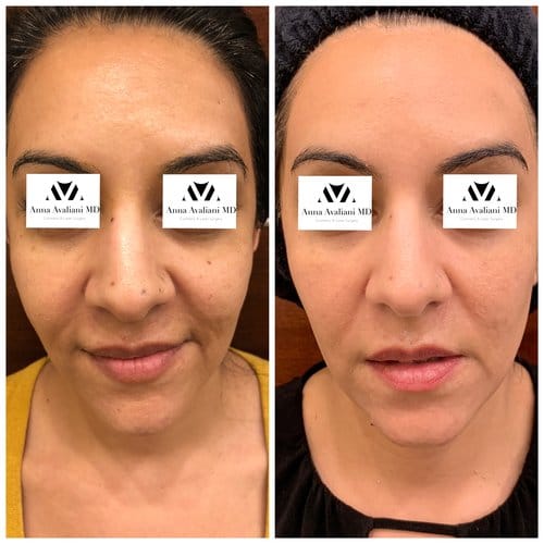 PicoSure / Laser Skin Rejuvenation before and after, result 17