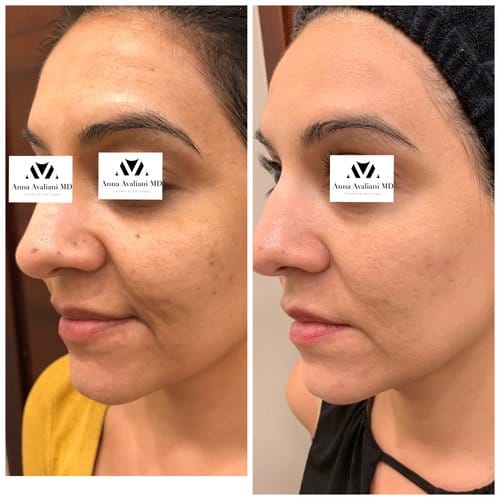 PicoSure / Laser Skin Rejuvenation before and after, result 18