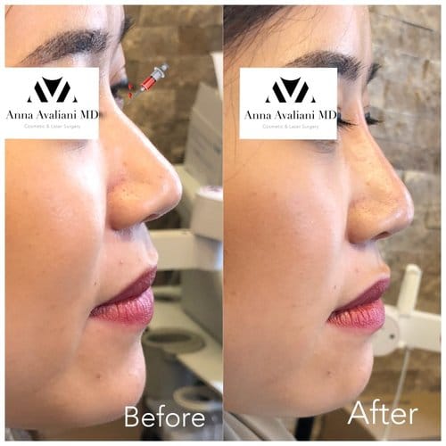 Non Surgical Nose Job before and after, result 15