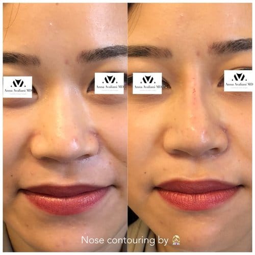 Non Surgical Nose Job before and after, result 16