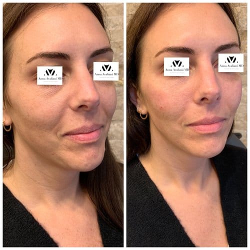 Fillers before and after