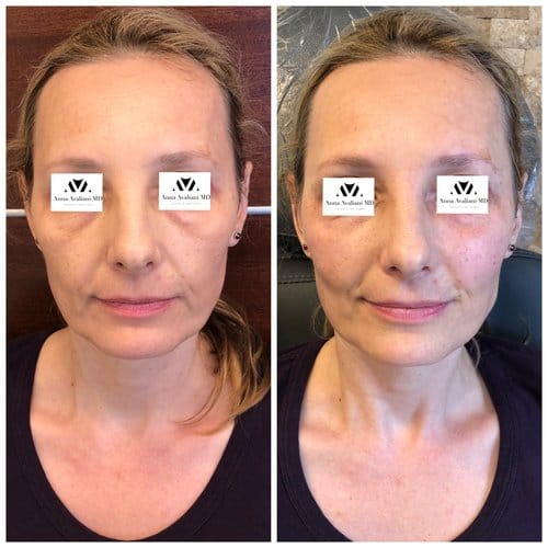 Fillers before and after