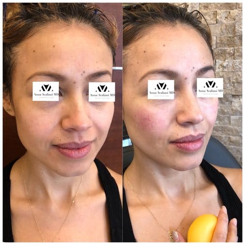 Fillers before and after, result 15