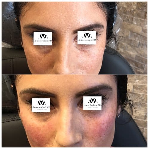 Fillers before and after, result 14