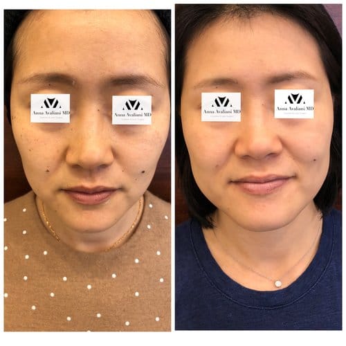 PicoSure / Laser Skin Rejuvenation before and after, result 19