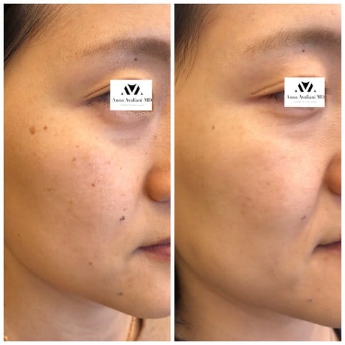 PicoSure / Laser Skin Rejuvenation before and after, result 20