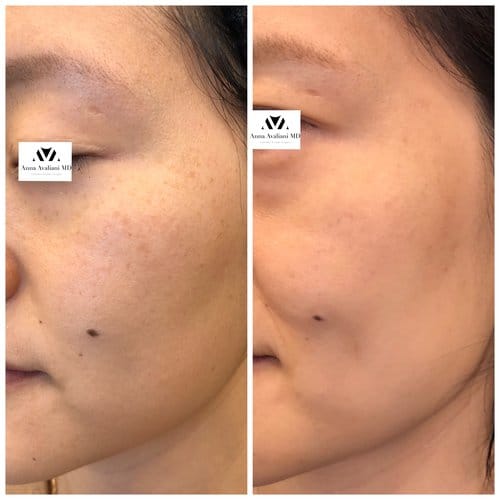 PicoSure / Laser Skin Rejuvenation before and after, result 21