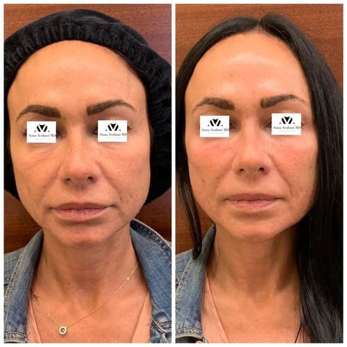 Fillers before and after, result 13