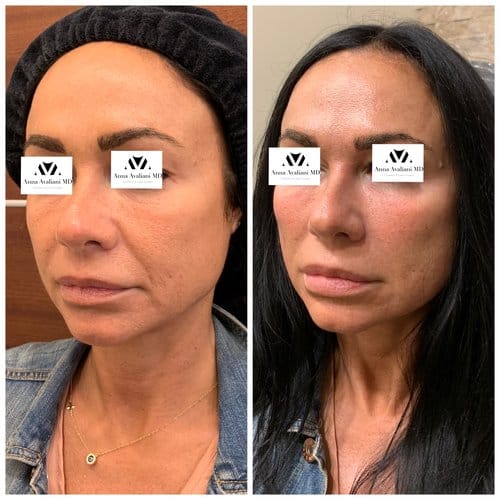 Fillers before and after, result 12