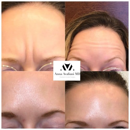 Botox before and after, result 30