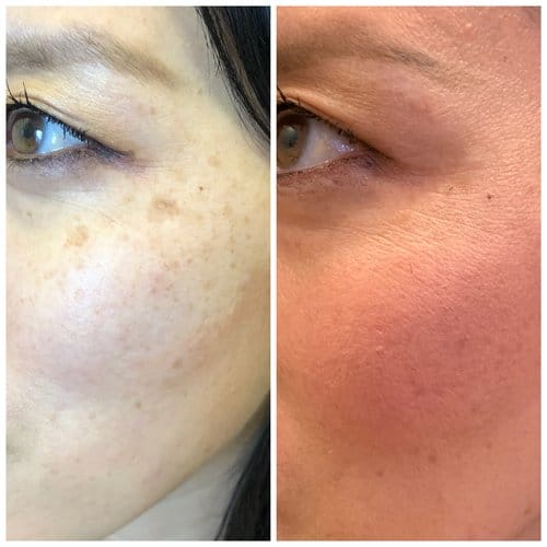 PicoSure / Laser Skin Rejuvenation before and after, result 28