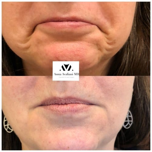 Botox before and after, result 29