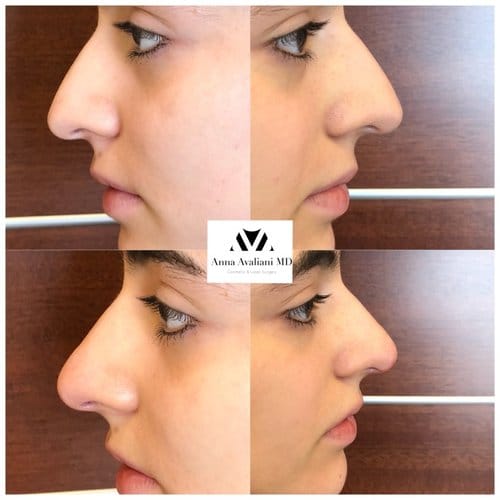 Non Surgical Nose Job before and after, result 17