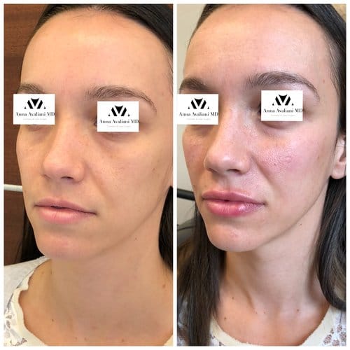 Fillers before and after, result 11