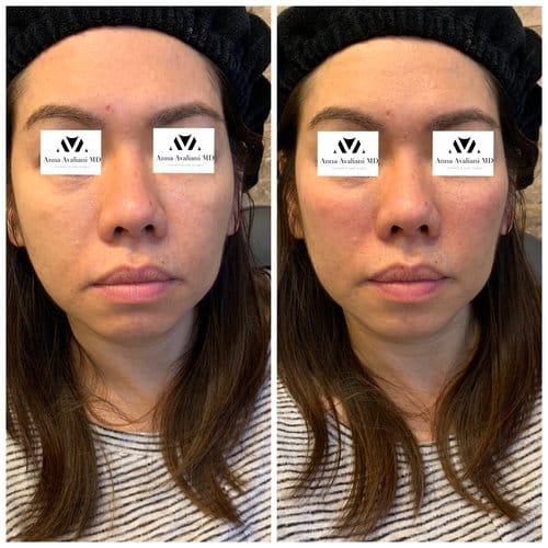Fillers before and after, result 10