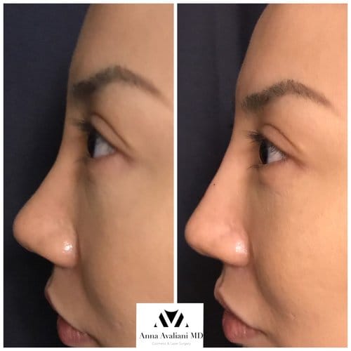Fillers before and after, result 31