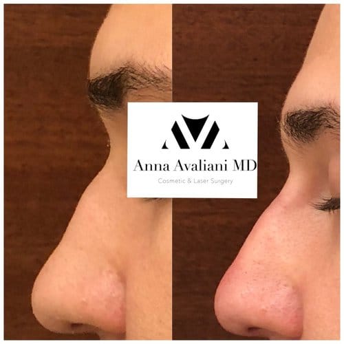 Non Surgical Nose Job before and after, result 18