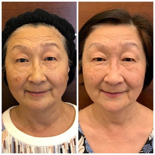 PicoSure / Laser Skin Rejuvenation before and after, result 29