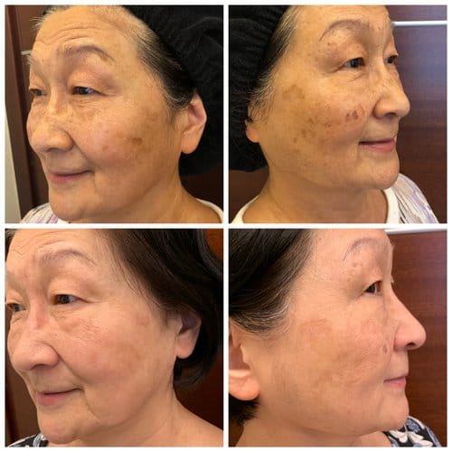 PicoSure / Laser Skin Rejuvenation before and after, result 30