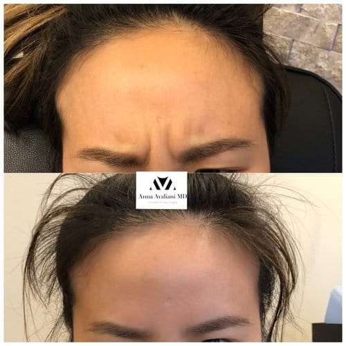 Botox before and after, result 28