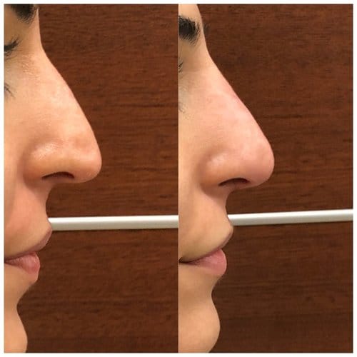Non Surgical Nose Job before and after, result 19
