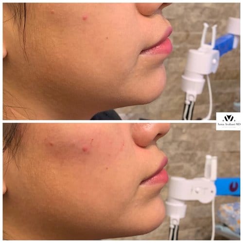 Non Surgical Chin Augmentation before and after