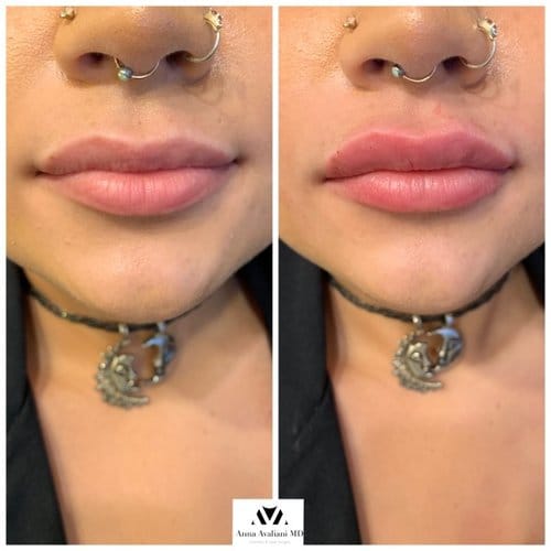 Lip Augmentation before and after, result 21