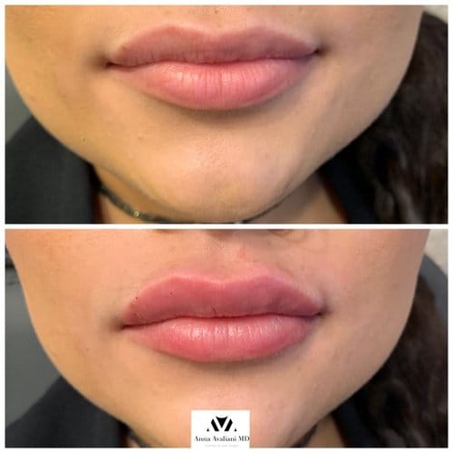 Lip Augmentation before and after, result 1
